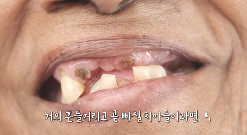 디오나비풀아치 무치악으로 고통받지 않도록! 관련 이미지 2