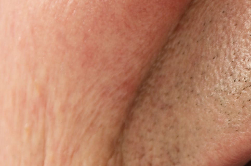 압구정로데오역 치과 불편한 틀니 대신 풀아치 임플란트! 관련 이미지 19