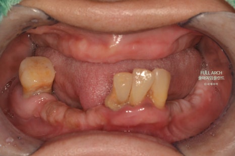 풀아치임플란트 무엇? full-arch Process 부작용과 주의할 점. 관련 이미지 5