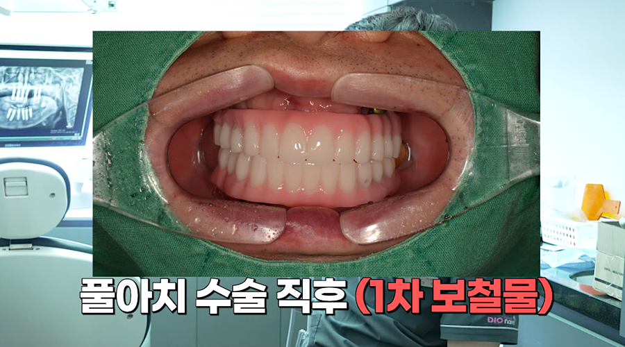 전체임플란트 수명 기간은 얼마나 관련 이미지 5