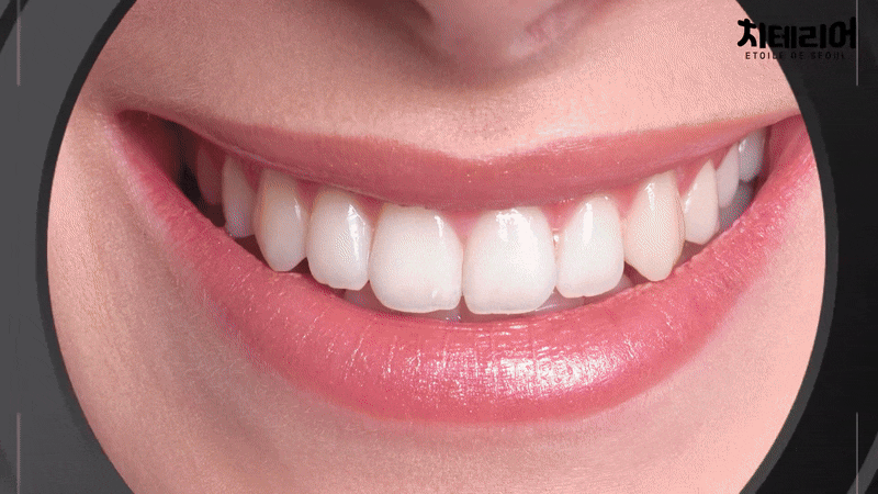 라미네이트 재시술 완벽한 미소를 위한 두 번째 여정 관련 이미지 7