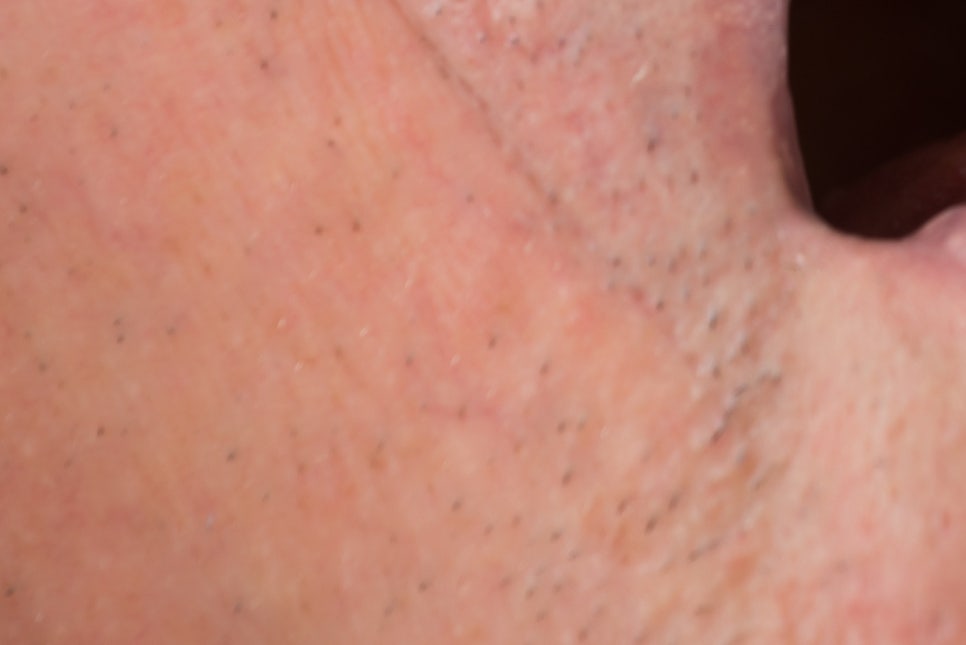 강남 노인임플란트 삶의 질이 달라져요 관련 이미지 15