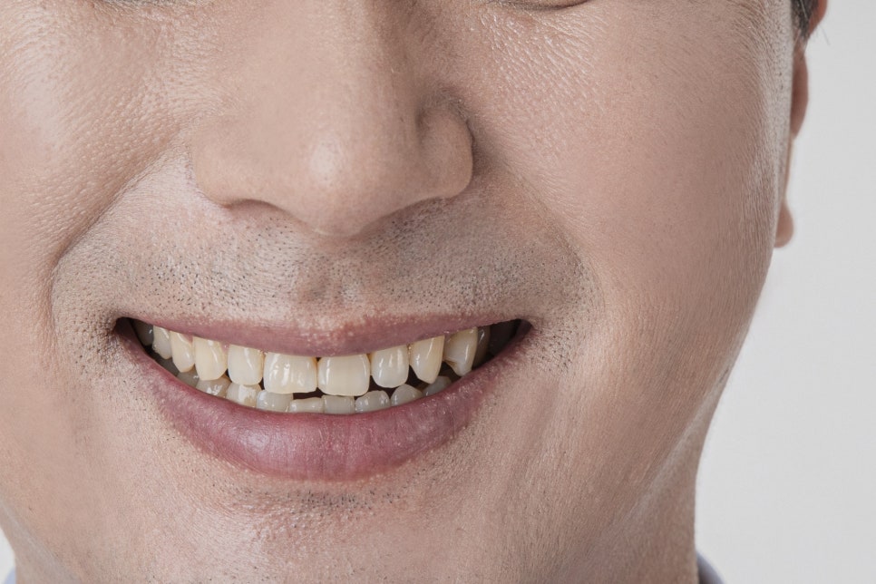 강남구 임플란트 세 가지 체크하고 결정하자! 관련 이미지 11