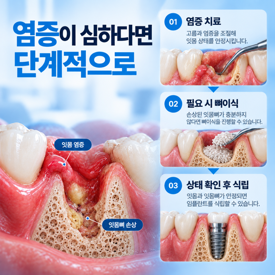 잇몸 염증 임플란트, 바로 심을 수 있을까요? 염증부터 치료해야 하는 경우 관련 이미지 5