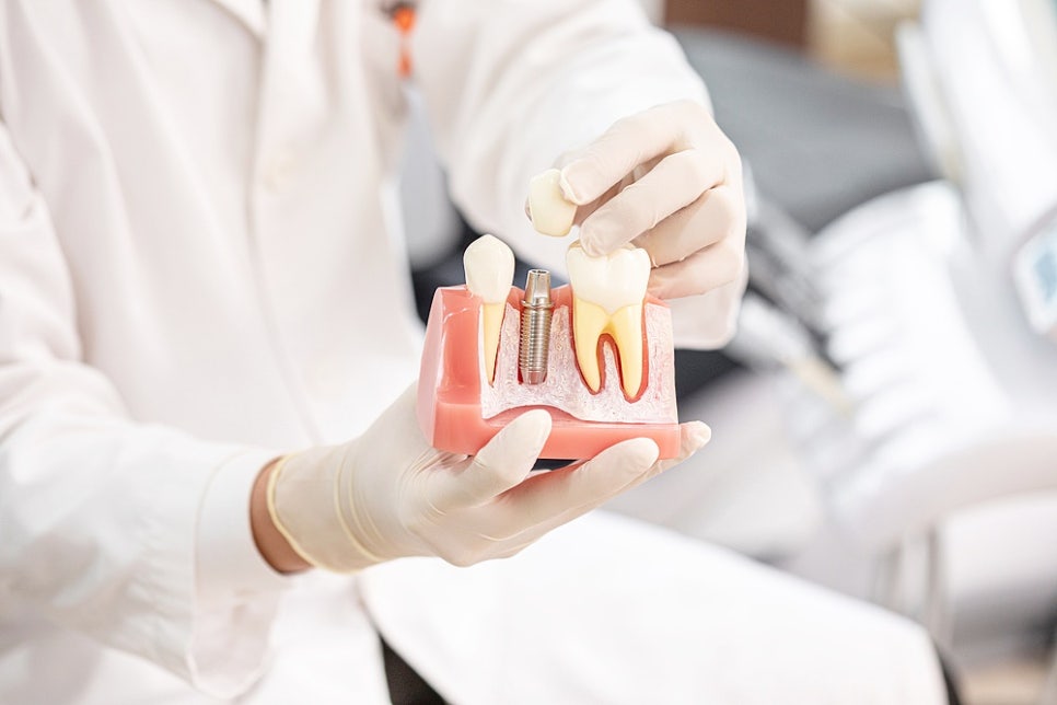 Why Does the Full-Arch Implant Price Vary by Clinic? image 9