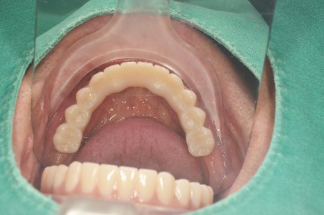 강남구청역 치과 임플란트 대체 방안 관련 이미지 6