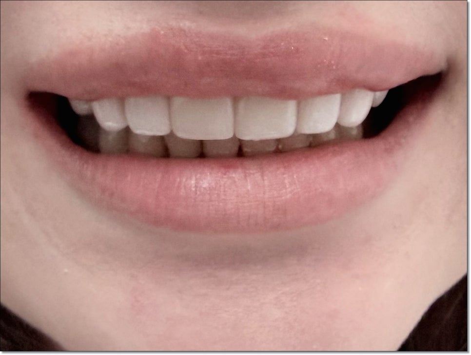 Cheongdam Partial Veneers for Front Teeth: Treat Only the Areas That Need It image 3