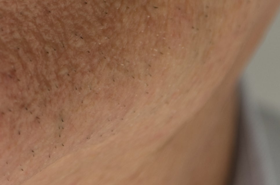 압구정로데오역 치과 불편한 틀니 대신 풀아치 임플란트! 관련 이미지 27