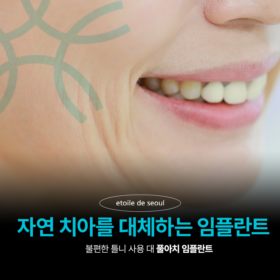 풀아치임플란트 잘하는곳 다수 식립 비용이 부담이라면 관련 이미지 5