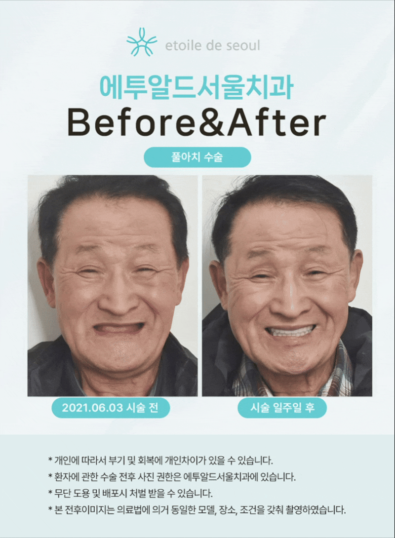 압구정치과 뼈이식 없는 임플란트 알아본다면 관련 이미지 3