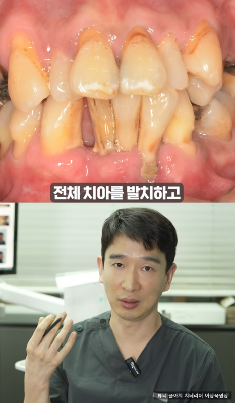 임플란트의 역사와 구조, 풀아치 임플란트 구조 차이점 비교 관련 이미지 11