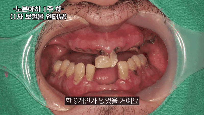 신사동 풀아치 임플란트 부작용 걱정된다면 먼저 확인하세요 관련 이미지 5
