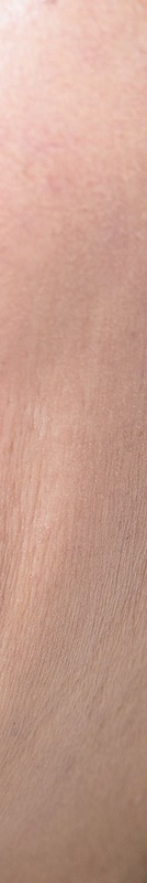 압구정치과 풀아치임플란트 회복기간 얼마나 필요할까 관련 이미지 39