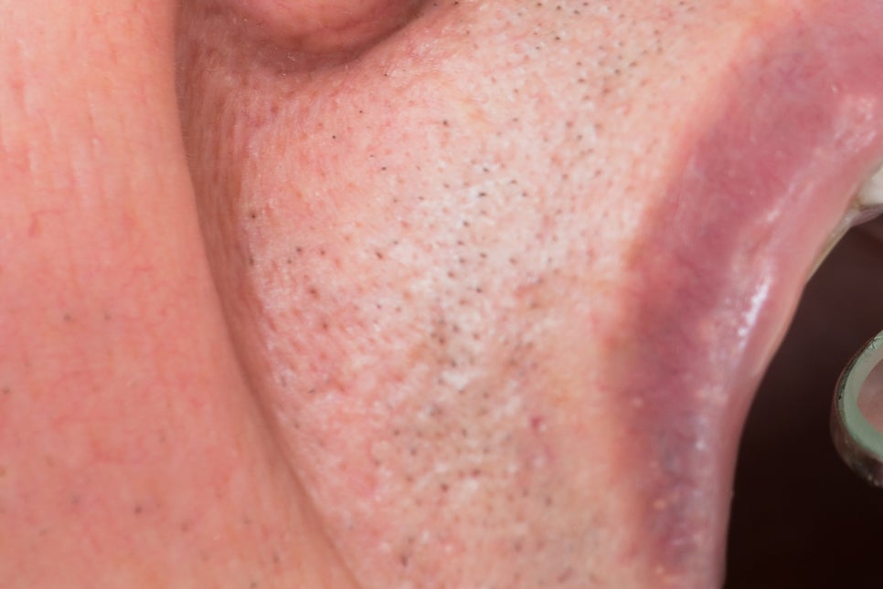 강남 노인임플란트 삶의 질이 달라져요 관련 이미지 12