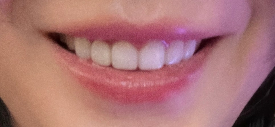 압구정무삭제라미네이트 시린 이 걱정된다면 관련 이미지 3