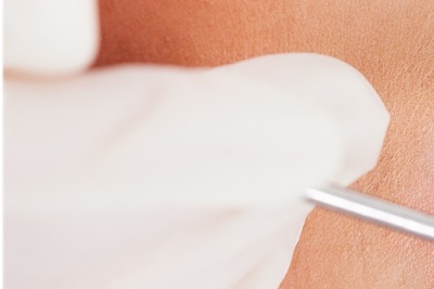 청담동치과 추천 앞니가 부러졌어요! 관련 이미지 13