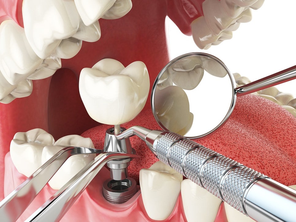 임플란트종류 장단점 확인해야 관련 이미지 6