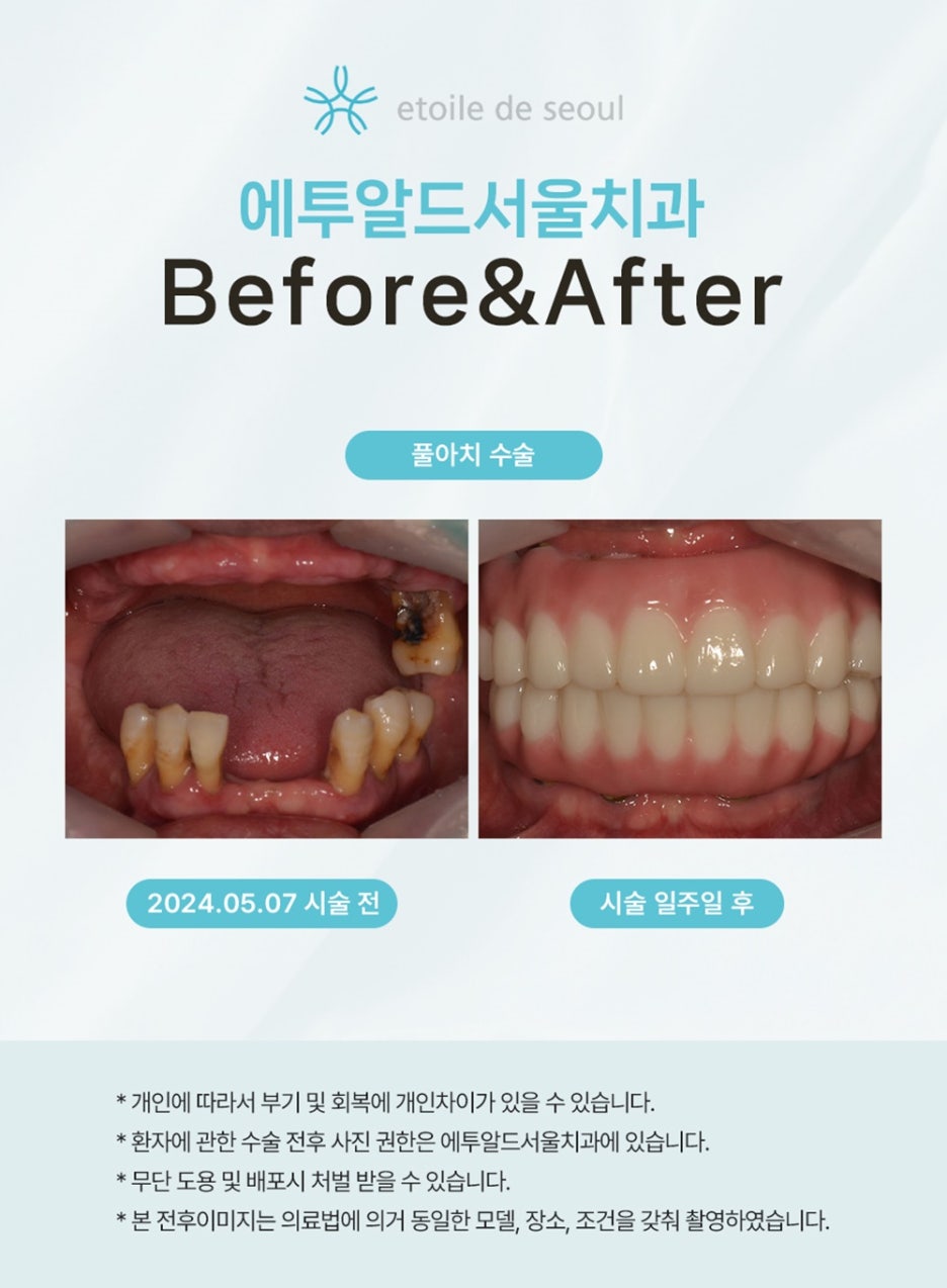 무치악임플란트로 다시 찾는 편안한 식사와 자신감 관련 이미지 6