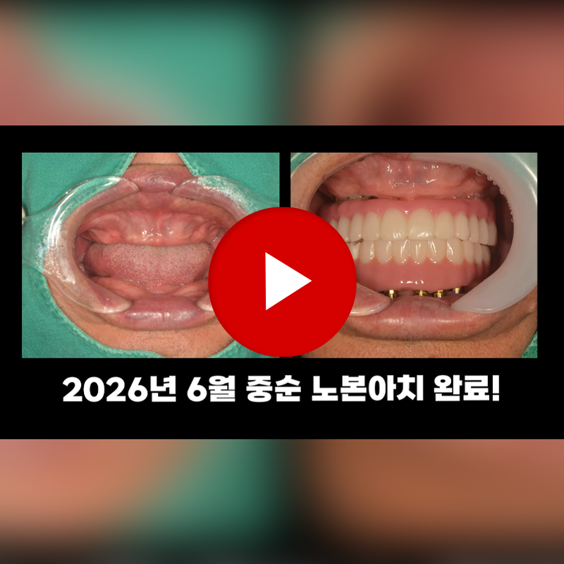 Complete Guide to National Health Insurance Coverage for Dental Implants for Seniors—from Eligibility to Out-of-Pocket Costs image 2