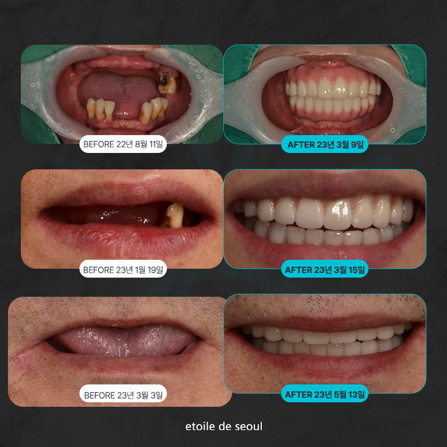 청담 어금니임플란트 저작하는 힘을 생각해 관련 이미지 4