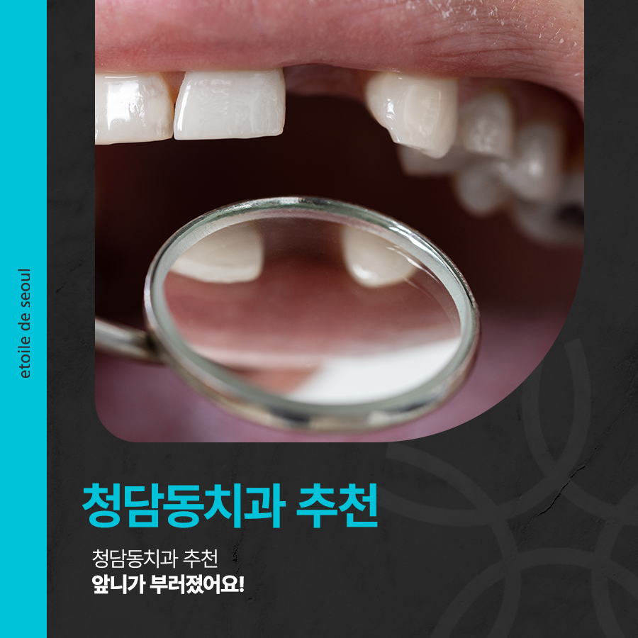 청담동치과 추천 앞니가 부러졌어요! 관련 이미지 1