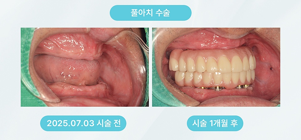풀아치 임플란트 임플란트 틀니 차이, 상담 때 가장 많이 나온 질문 관련 이미지 12