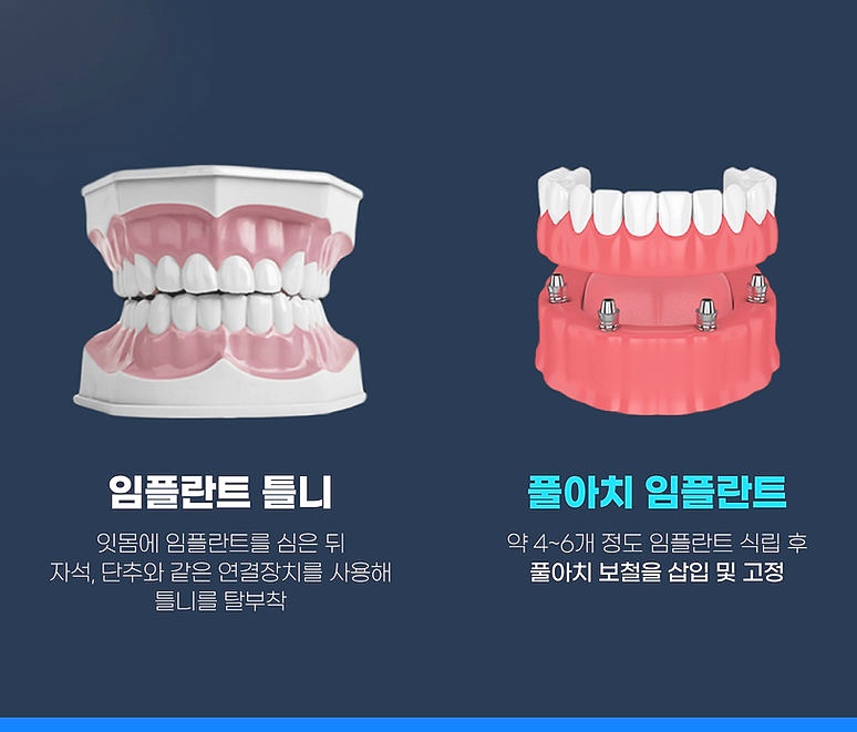 강남임플란트잘하는곳 치과 자세하게 알아보세요 관련 이미지 5