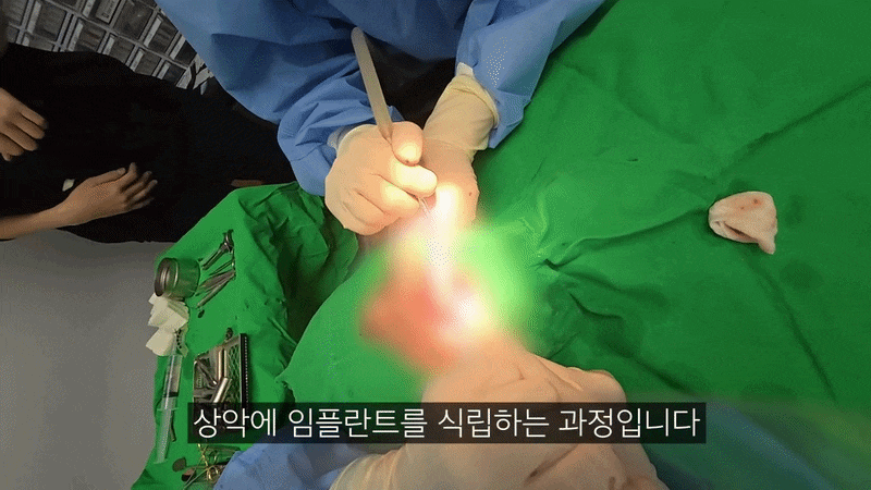 Wondering How Long Full-Arch Implant Surgery Takes? image 8