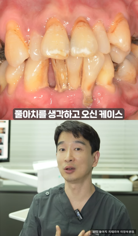 임플란트의 역사와 구조, 풀아치 임플란트 구조 차이점 비교 관련 이미지 12