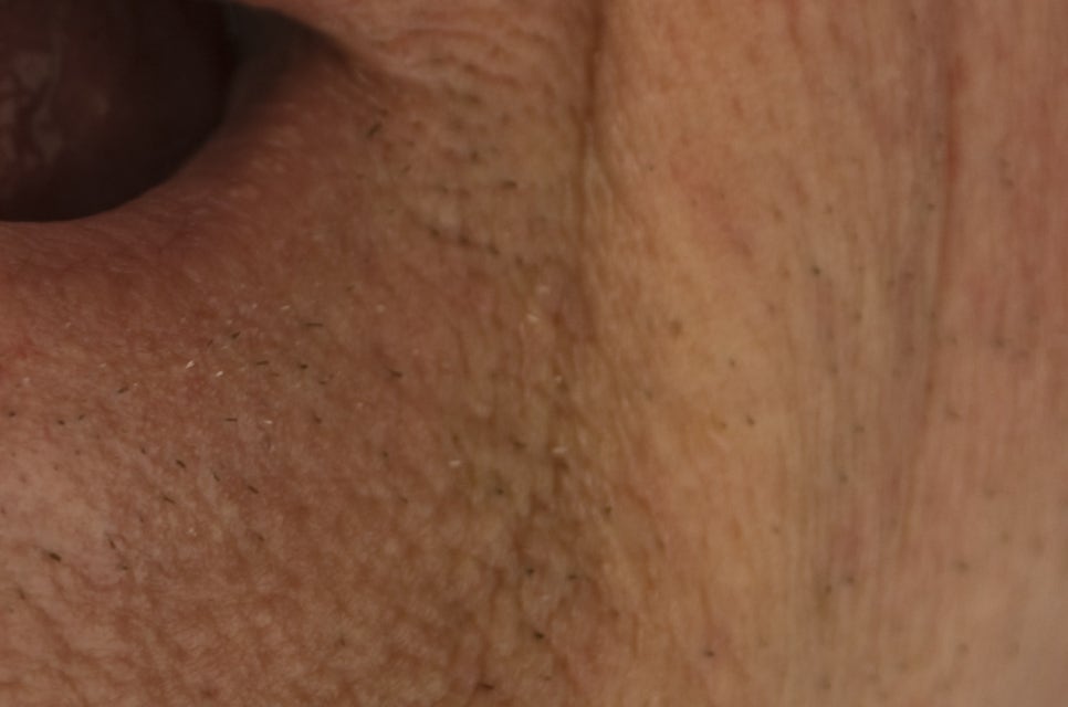 압구정로데오역 치과 불편한 틀니 대신 풀아치 임플란트! 관련 이미지 24