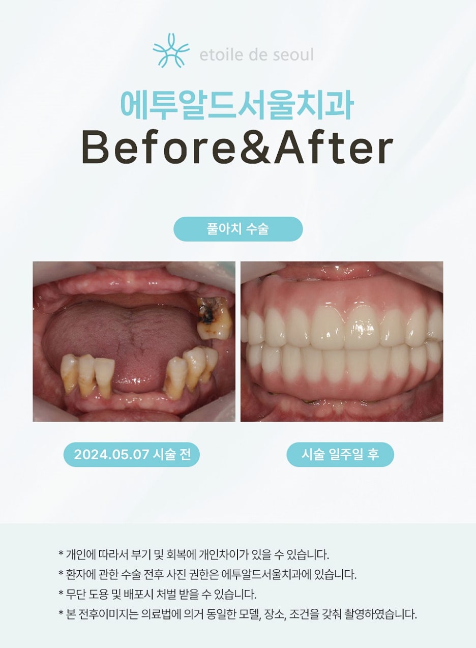 65세이상임플란트지원 혜택 조건 확인하기 관련 이미지 3