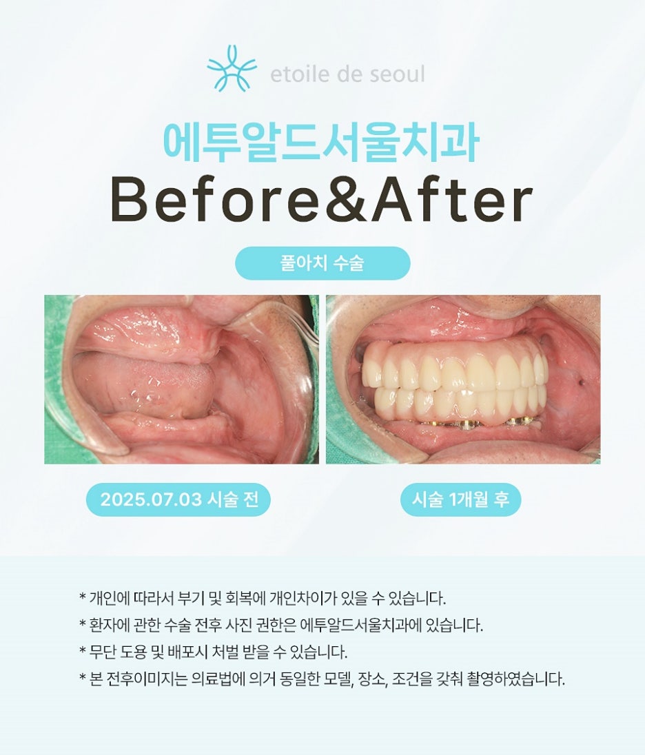 전악임플란트 저작력 되살리는 방법 관련 이미지 3