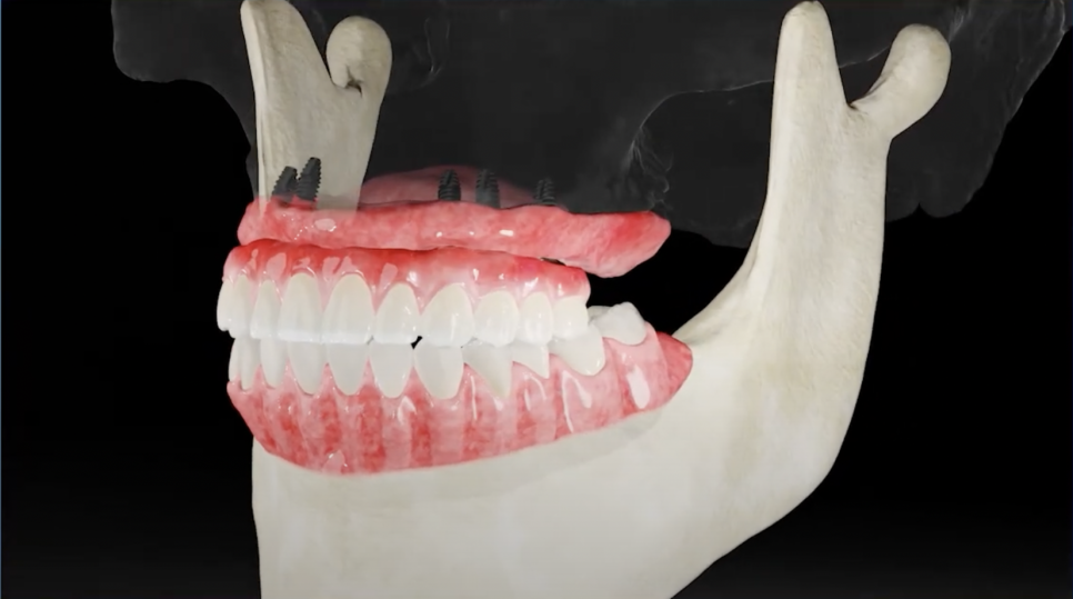 풀아치 임플란트 왜 풀아치정품보철 이어야 할까? 관련 이미지 3