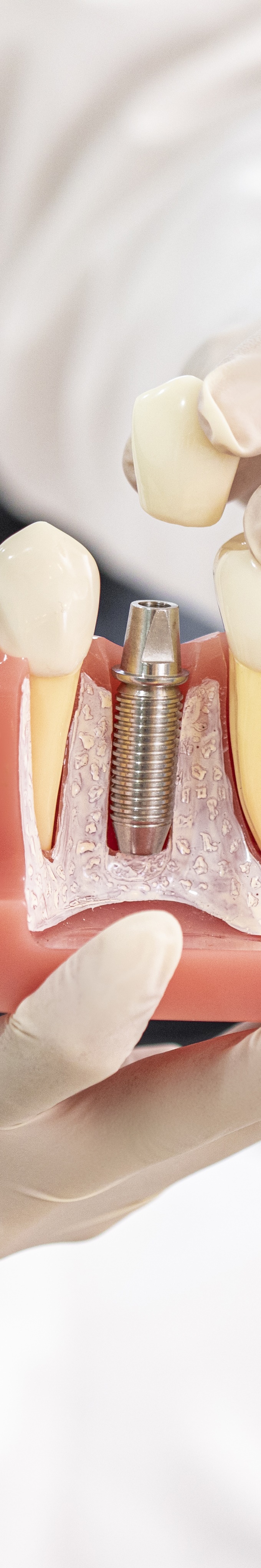 청담동임플란트 선택 전 꼭 알아야 할 사실들 관련 이미지 27