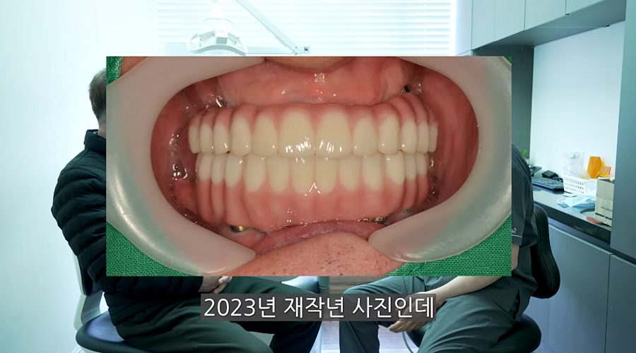 전체임플란트 수명 기간은 얼마나 관련 이미지 7