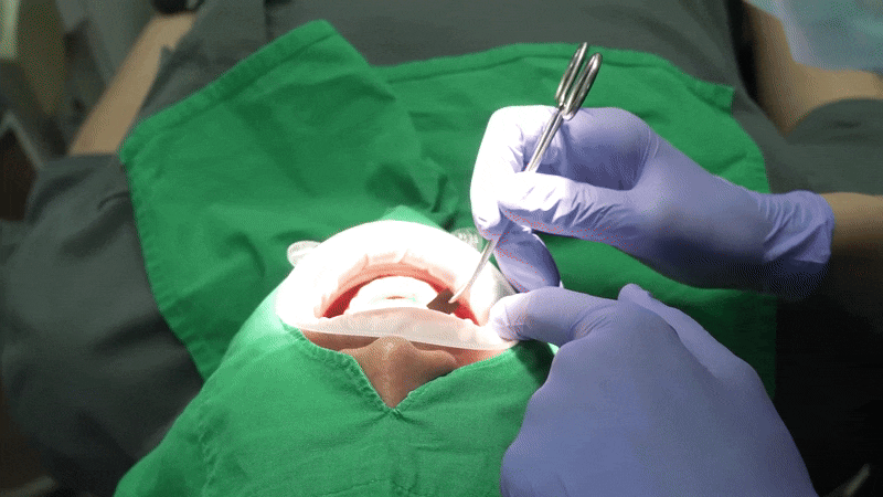 풀아치임플란트후기 결정 전 확인해야할 사항 관련 이미지 10