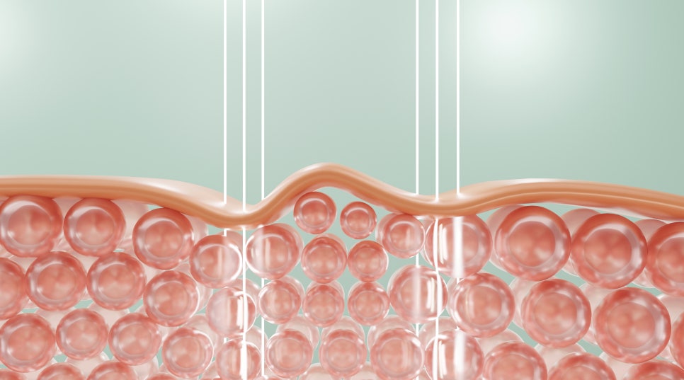 Toxnfill Gangnam Branch: Improving Sagging Neck Skin image 3