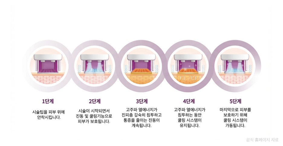 서초구써마지 리프팅 샷수, 많을수록 효과적일까? 관련 이미지 7