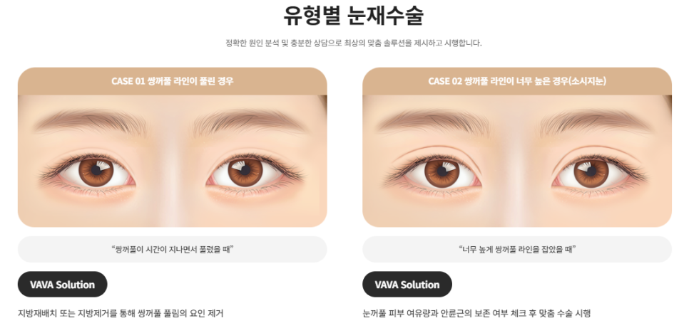 Revision Double Eyelid Surgery May Not Be Just a Line Issue | When Revision Eyelid Surgery Is Needed at Baba Plastic Surgery image 2