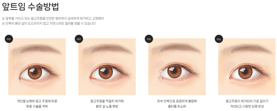 If You’re Concerned About a Tight-Looking Eye Shape | When Medial Epicanthoplasty & Upper Epicanthoplasty Are Needed and How They Differ at 바바성형외과 image 9