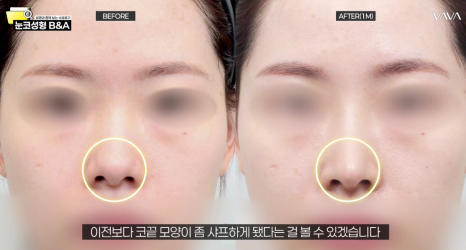 복코 매부리코 긴코 교정 ㅣ 코성형 전후 케이스 (NJZ민지 코) 관련 이미지 10