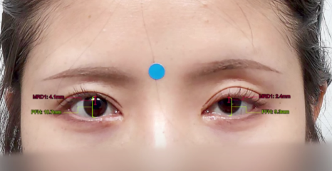 쌍수 후 생겨버린 짝눈 교정 눈의 균형을 맞추는 섬세한 방식 관련 이미지 2