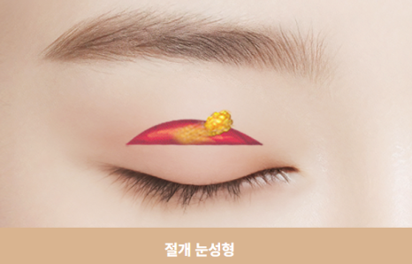 쌍꺼풀 수술 짧은 회복기 가능? 종류별 차이 완전 정리 관련 이미지 3