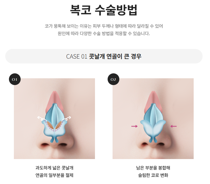 압구정 바바성형외과 자가늑 코성형 후기｜복코&middot;매부리코 교정 한달차 변화 관련 이미지 11