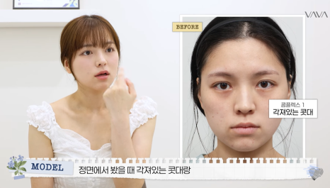 보형물 없이 선명하게｜바바성형외과 무보형물 매부리코 교정 리얼 후기 관련 이미지 18