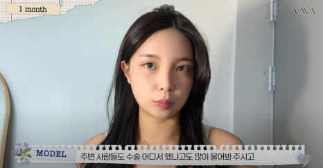 쌍수 재수술 성공기 ｜ 졸려보이는 눈 세미아웃으로 예뻐진 리얼 Before & After 관련 이미지 14