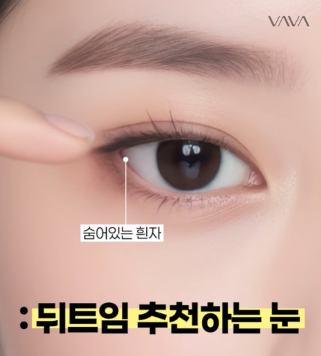 뒤밑트임 수술, 잘 되는 눈 따로 있습니다｜추천 대상&middot;부작용&middot;재유착 정리 관련 이미지 15