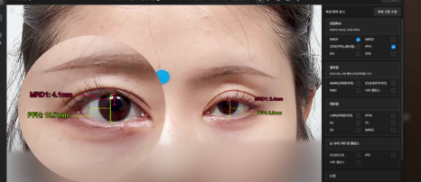 쌍수 후 생겨버린 짝눈 교정 눈의 균형을 맞추는 섬세한 방식 관련 이미지 3