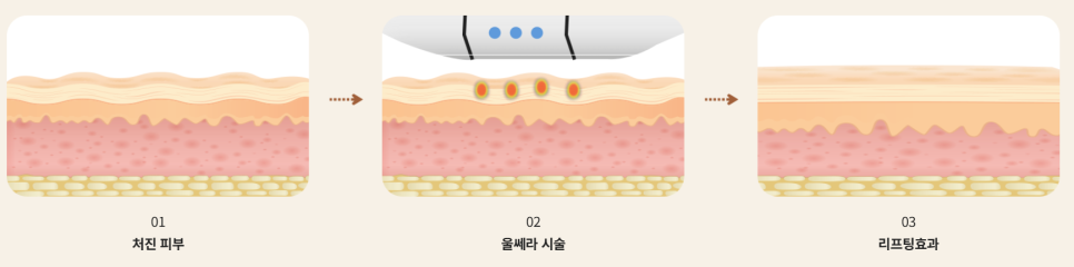 울쎄라 효과 언제부터? 윤곽까지 바뀌는 리프팅, 압구정 바바성형외과(리얼후기) 관련 이미지 12