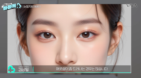 눈밑지방재배치 vs 하안검 vs 필러, 나는 어떤 케이스일까? | 압구정 바바성형외과에서 알려드립니다 관련 이미지 11